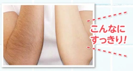 パイナップル豆乳除毛クリーム　ビフォー　アフター
